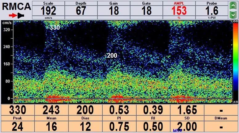 缺血性卒中颈血管超声检查完成率,颈动脉超声脑卒中