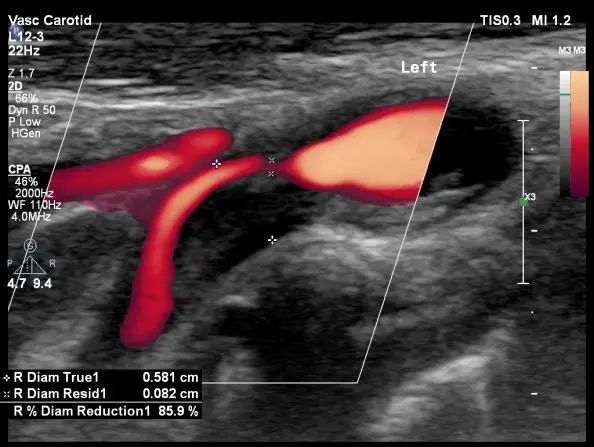 缺血性卒中颈血管超声检查完成率,颈动脉超声脑卒中