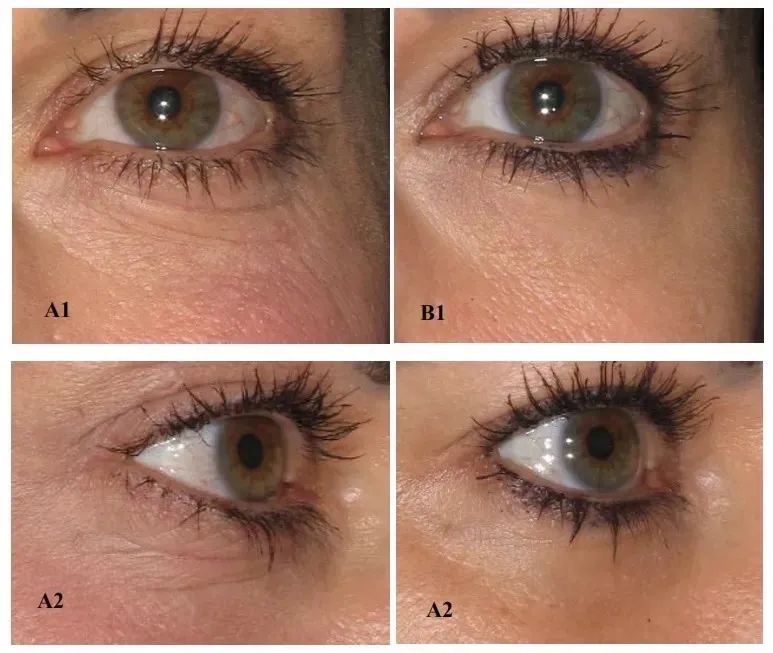 家用射频美容仪会让角质层变薄吗,家用射频美容仪会让脸僵硬吗