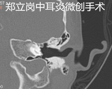 耳鼓膜穿孔一定要做手术吗,耳朵鼓膜穿孔手术费用多少