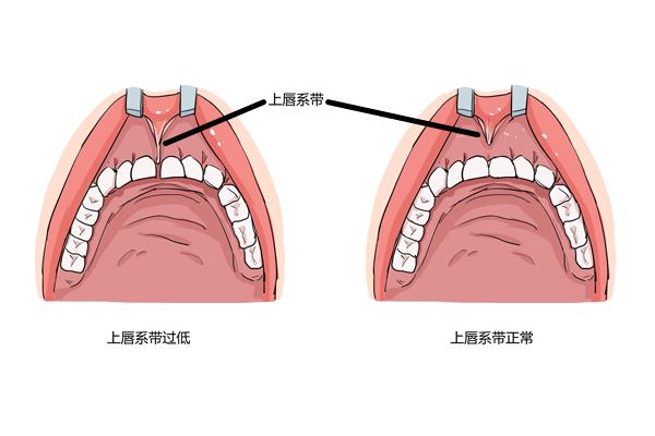 大人的上唇系带,上唇的系带太长