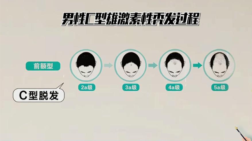 如何拯救“秃”如其来的尴尬？今晚19:30，收看海南卫视，为您揭晓答案