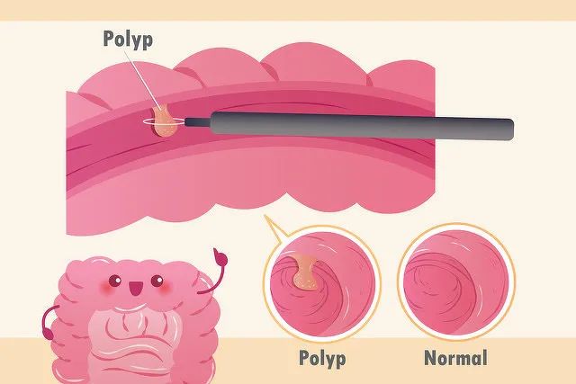 身上长囊肿结节息肉是怎么回事,结节息肉囊肿老中医教你一招