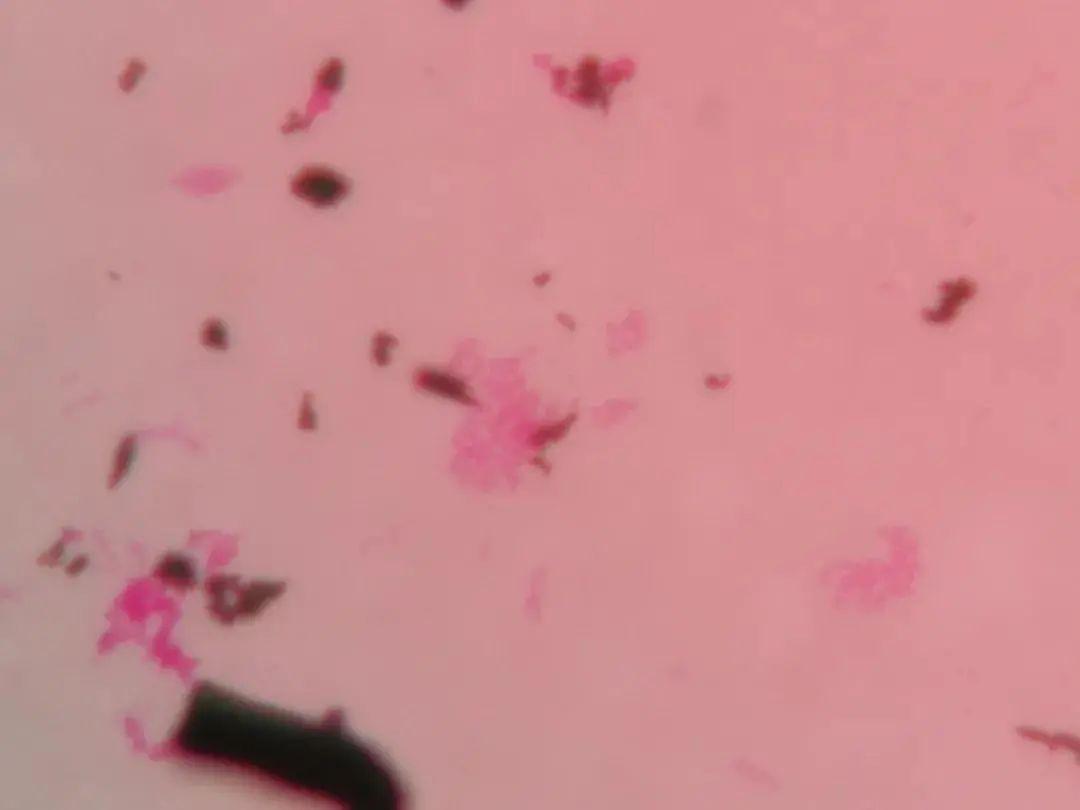 喝了口“现挤鲜奶”，足足发烧了5天，还差点要了命