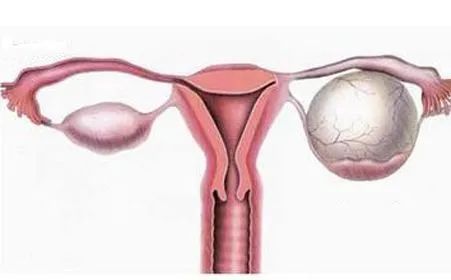 从“卵巢囊肿”到“卵巢癌”，究竟需要多久？