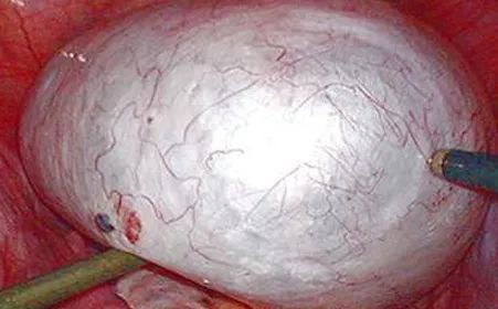 从“卵巢囊肿”到“卵巢癌”，究竟需要多久？