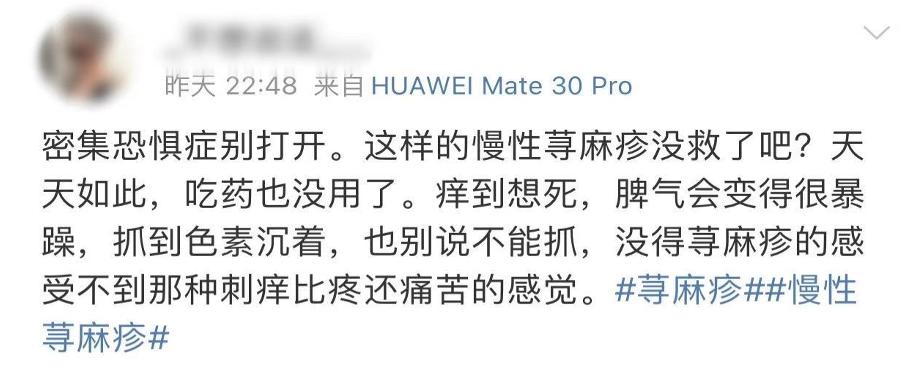 荨麻疹痒得要死,孩子荨麻疹痒死了怎么办