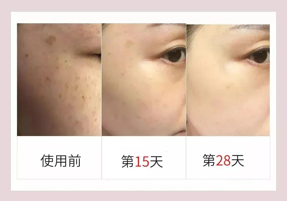 花了3万做激光，才彻底懂了：医生为什么劝你别去斑