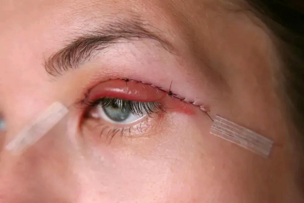 有效淡化疤痕的六个小妙招,贴上疤痕贴也长疤痕