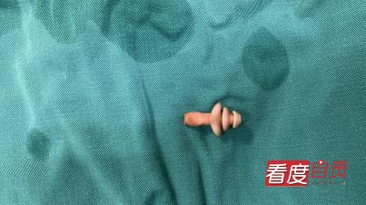 3-6岁儿童异物入体,五岁女宝宝有白色的异物还有异味