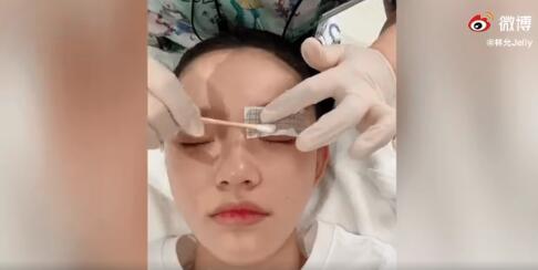 林允打水光血珠,林允打水光针术后恢复