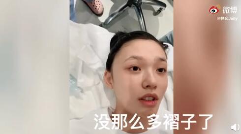 林允打水光血珠,林允打水光针术后恢复