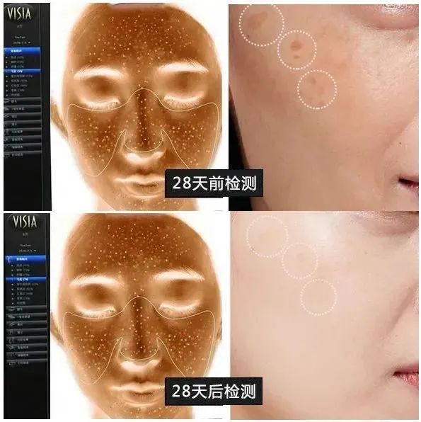 花了3万做激光，才彻底懂了：医生为什么劝你别去斑