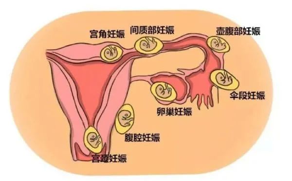 异位妊娠的金标准是什么,异位妊娠b超有哪些表现