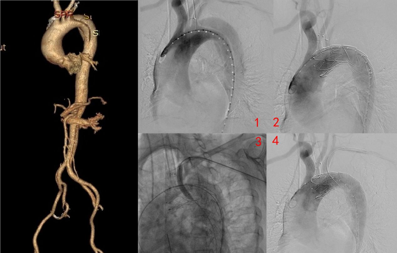 山大医院主动脉夹层,山医大二院支架植入术