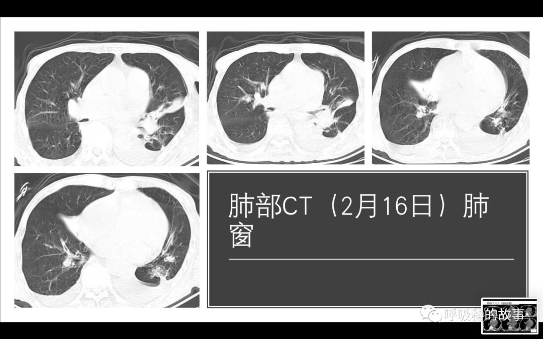 痰液培养阳性是否一定要用抗菌素？——为什么临床微生物学思维很重要（2）