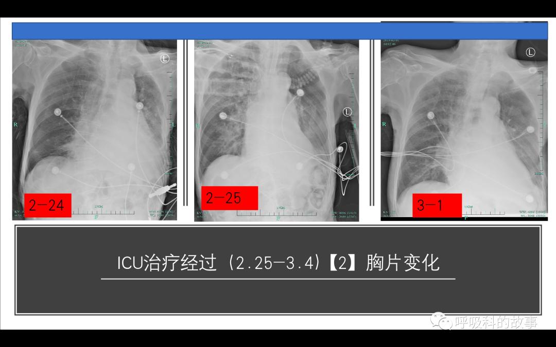 痰液培养阳性是否一定要用抗菌素？——为什么临床微生物学思维很重要（2）