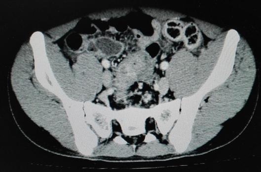 肌纤维母细胞瘤成功案例,炎性肌纤维母细胞瘤最佳治疗方案
