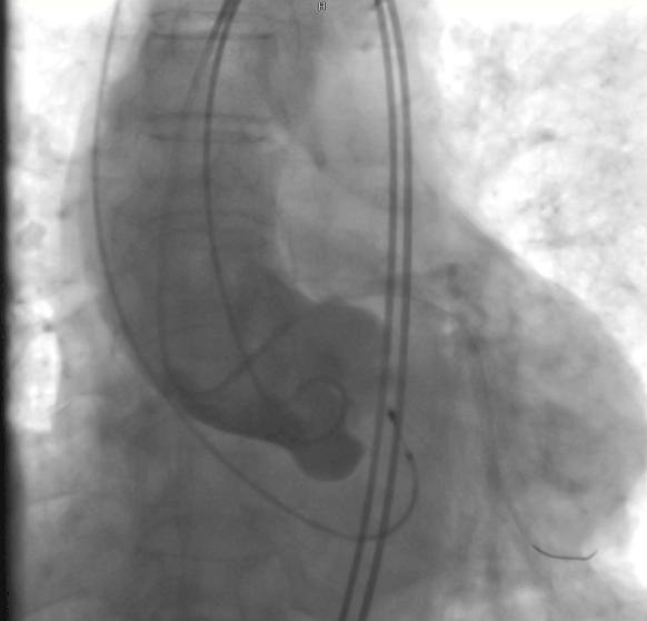74岁老人心脏大能换瓣膜吗,73岁老人心脏瓣膜手术成功率