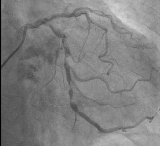 74岁老人心脏大能换瓣膜吗,73岁老人心脏瓣膜手术成功率