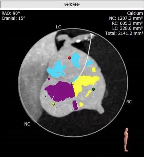 74岁老人心脏大能换瓣膜吗,73岁老人心脏瓣膜手术成功率