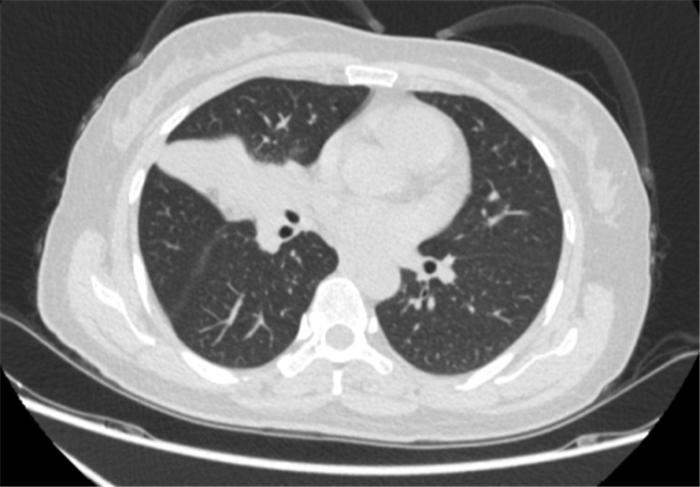 肿瘤的姑息治疗或辅助治疗根治,肿瘤的免疫治疗和介入治疗