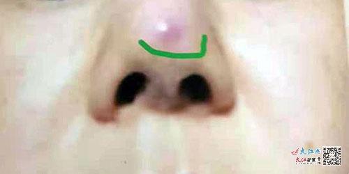 隆鼻鼻子斜歪是怎么回事,隆鼻手术七天后发现鼻子歪