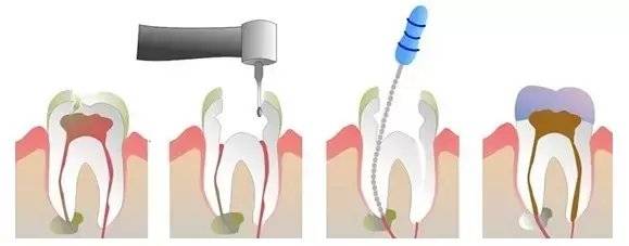 小朋友不适合做根管治疗怎么办,4岁孩子做根管治疗需要拍片吗