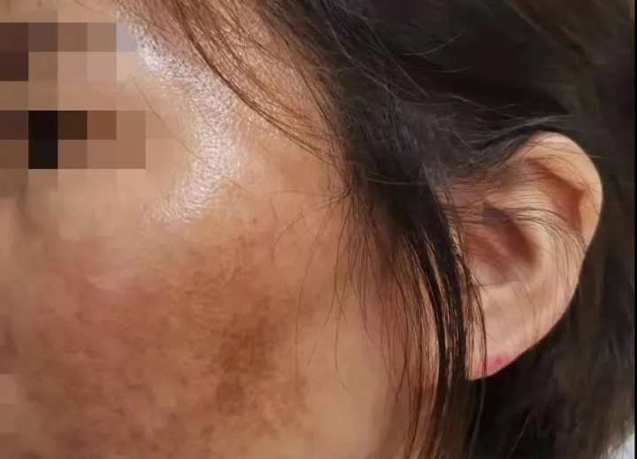 杭州女子美容毁容,杭州女子祛斑被毁容后续