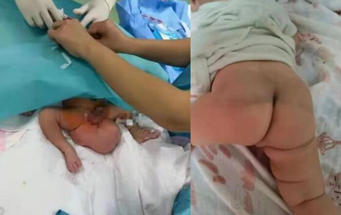 产检查出胎儿右肾有囊肿咋办,胎儿臀部肿瘤