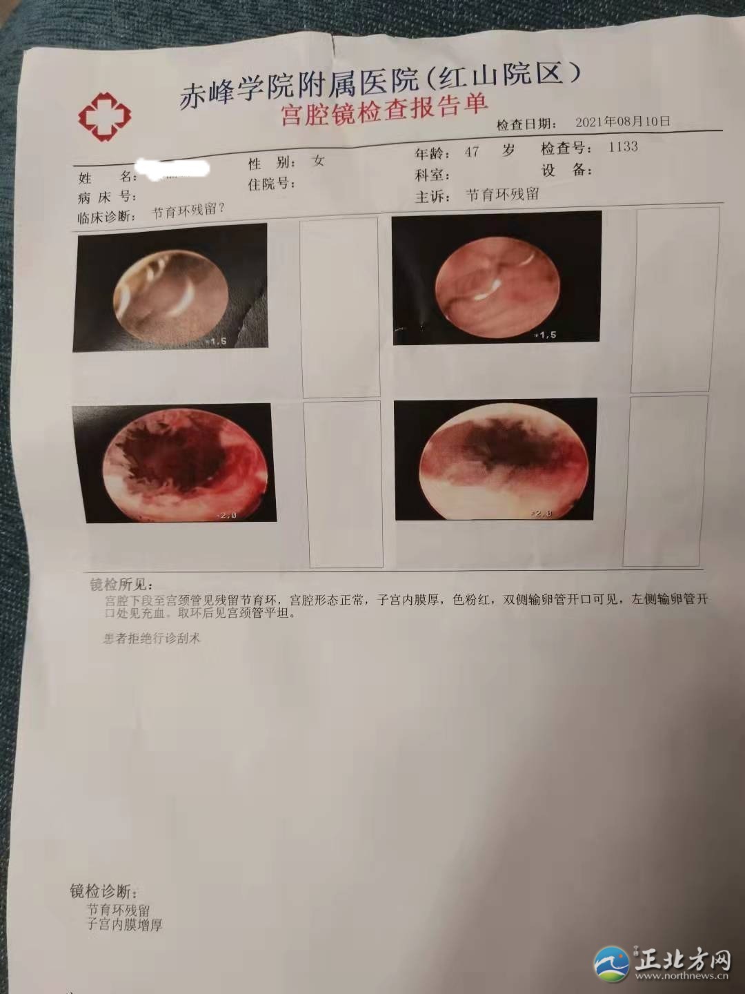 郭女士取环手术半年后环还在，记者采访被报警……