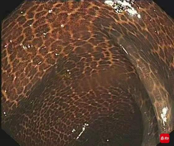 吃减肥酵素肠子像蛇皮,长期吃减肥酵素对肠道有什么损害