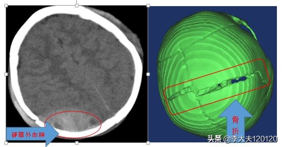 孩子额头被东西砸伤怎么处理,儿童头部摔伤后该如何做应急处理