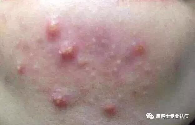 库博士祛痘痘效果怎么样,库博士专业祛痘长沙