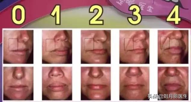 消灭法令纹护肤大法,如何正确嘟嘴消灭法令纹