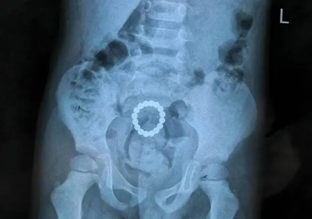 一个小孩儿肚子里有15颗磁力珠,儿童肚子里面有颗磁力珠