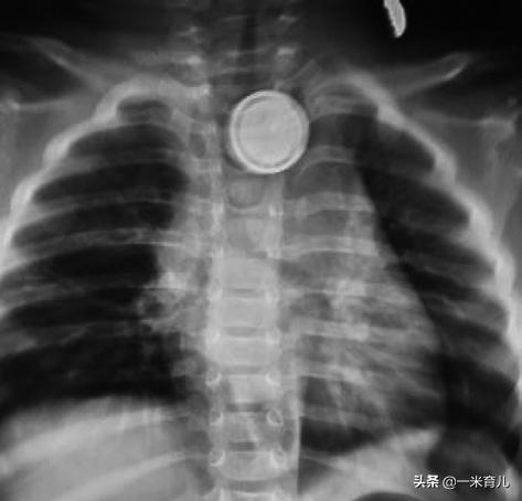 儿童小异物,宝宝吞食异物急救