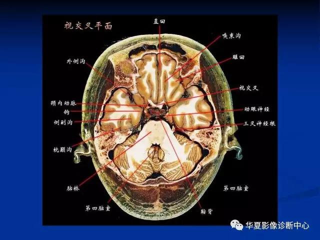 mra头颅解剖学详细讲解视频,常见的头颅mri图像