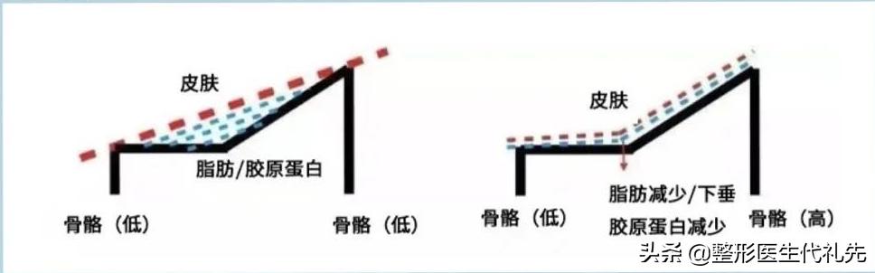 从整形医生的角度讲解,法令纹到底怎么能彻底解决