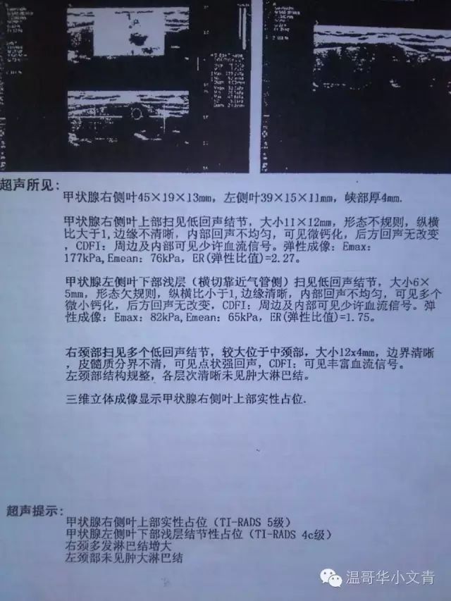 甲状腺癌存在过度治疗,被严重低估的甲状腺癌