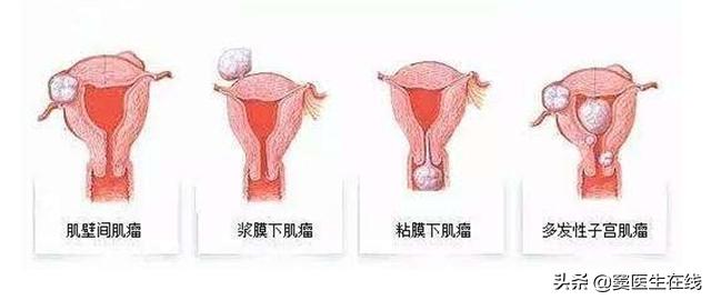 子宫肌瘤有没有可能恶变,子宫肌瘤有恶变的人多吗