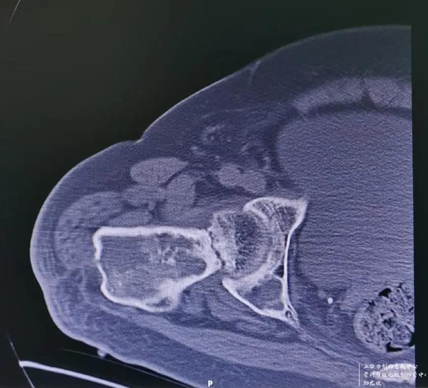 男子脚骨折去医院,男子脚伤手术后仍一瘸一拐