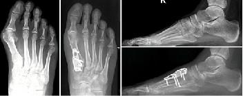 拇外翻大脚趾疼如何在家就能治,大脚拇指痛要警惕