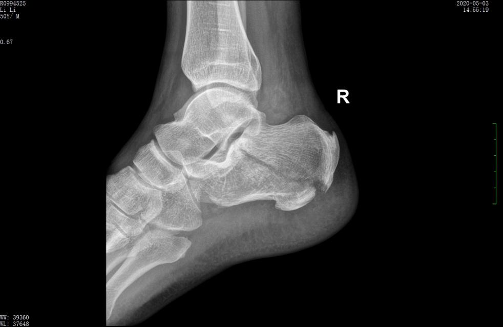 左股骨粗隆间粉碎性骨折微创手术,跟骨粉碎性骨折微创手术最快多久