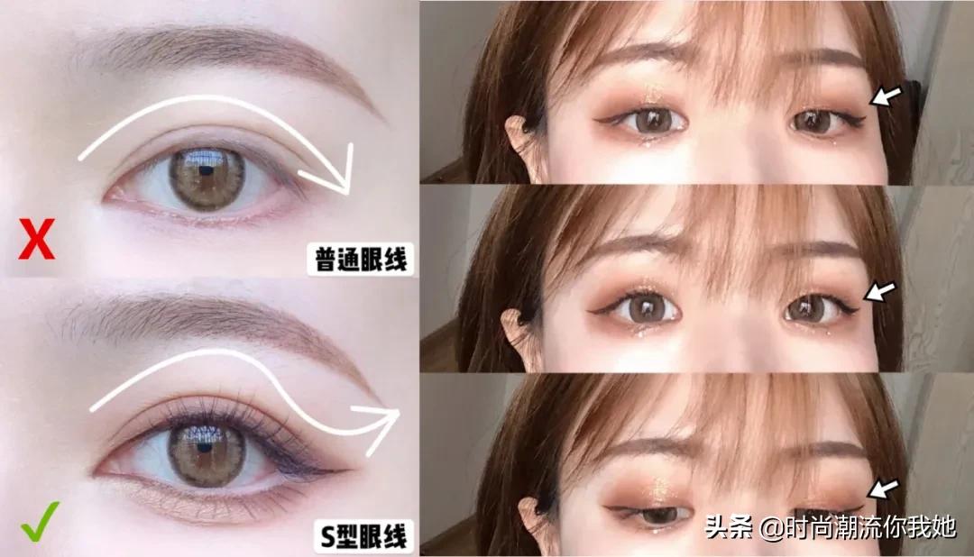 单眼皮凸嘴素人改造,肿眼泡整容成功案例