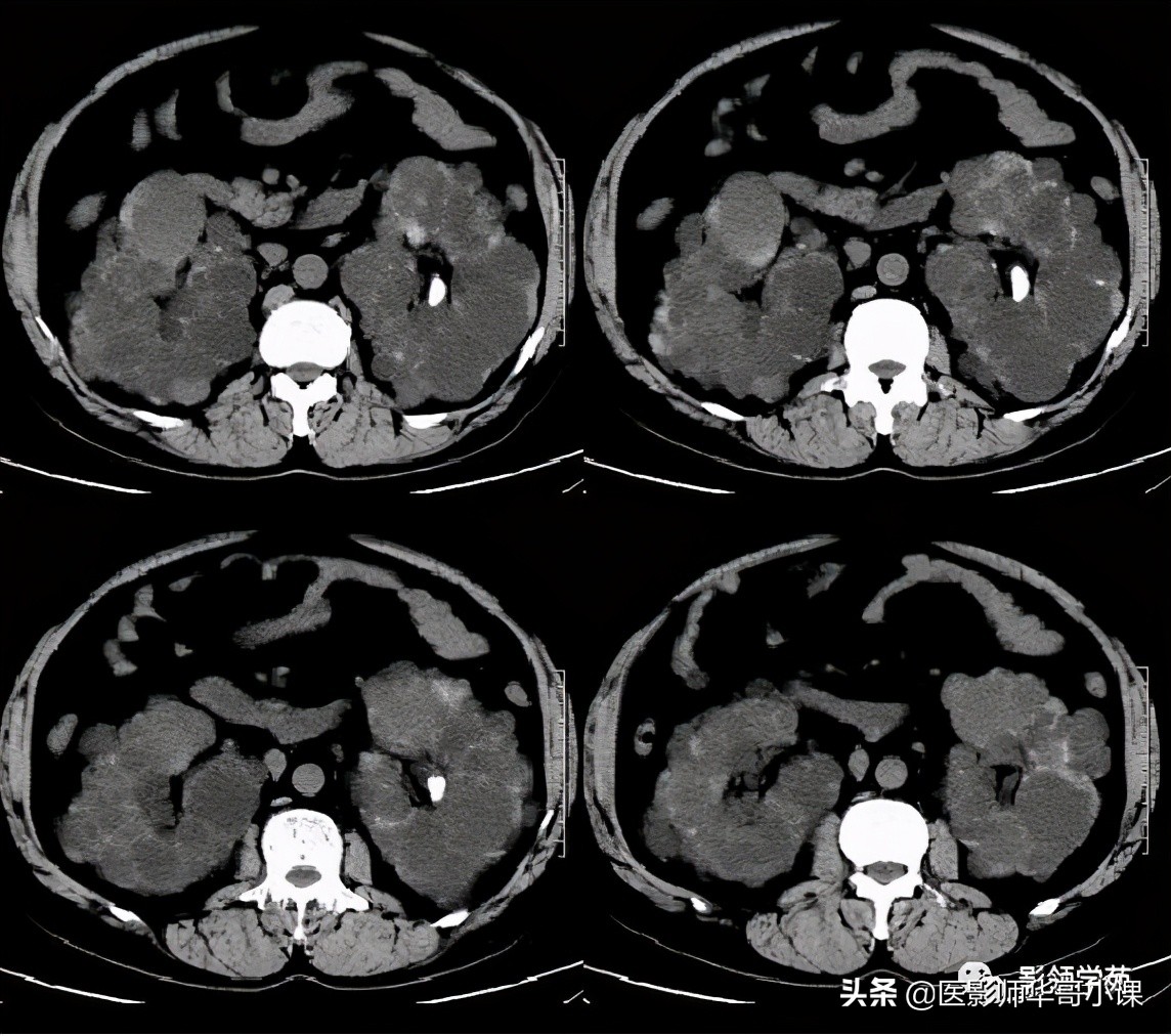 胆总管变异,胆胰管解剖