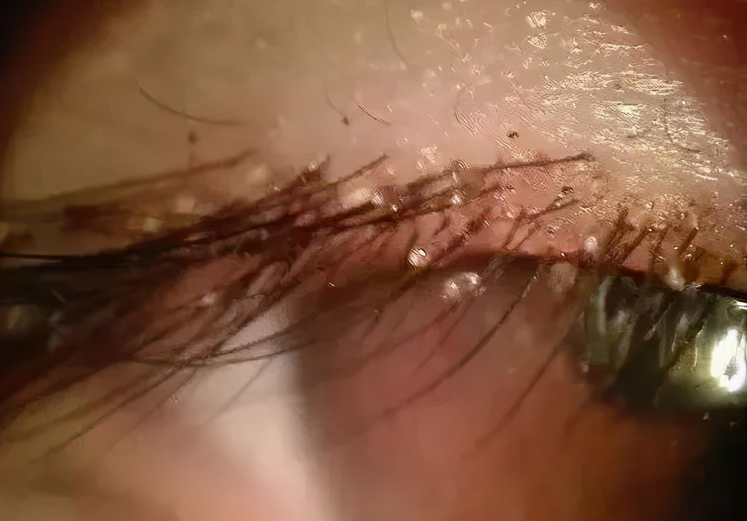 小孩眼睛痒是有虫子吗,儿童眼痒掏出六条虫