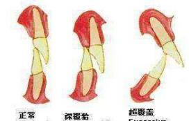 小孩子一笑露牙龈怎么办,一笑就露牙龈有什么说法