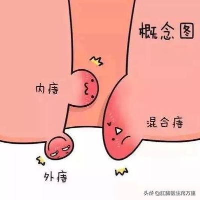 长期便血几年是痔疮还是直肠癌,便血怎么判断是痔疮还是直肠息肉