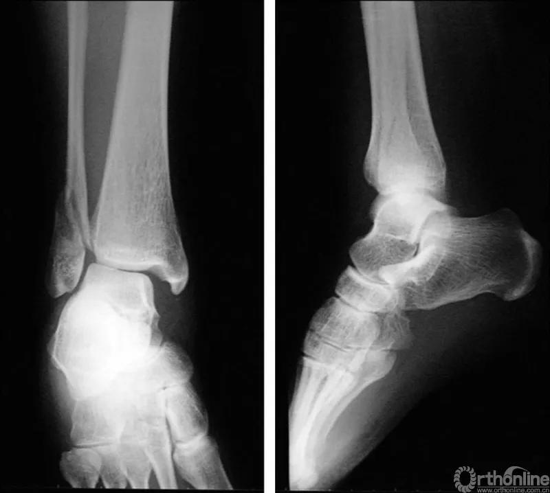 骨折闭合复位髓内钉内固定术,骨折闭合复位